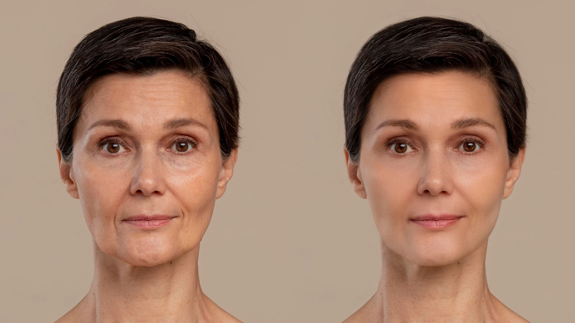 hyaluronic acid before and after