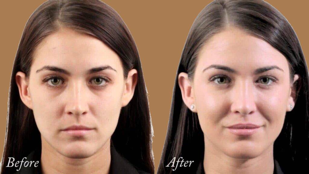 enhance cheek volume with fillers los angeles 1024x576 (1)